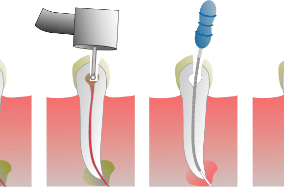 What Happens If I Don’t Get A Crown After My Root Canal?