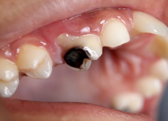 Rotten teeth: Causes, Symptoms and Treatment